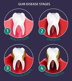 stages of gum disease, Saint Albans, VT
