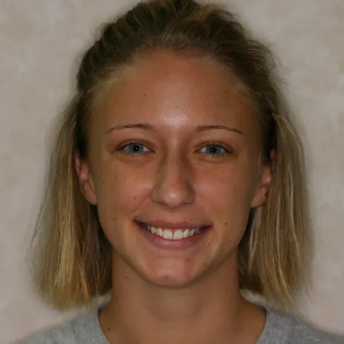 Heather before smile image