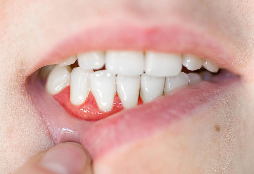 Close-up-Of-Teeth-Gum-Disease
