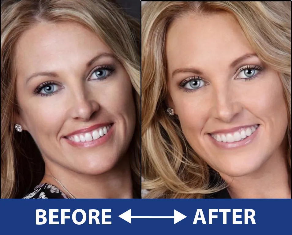 Side by Side smile image 2