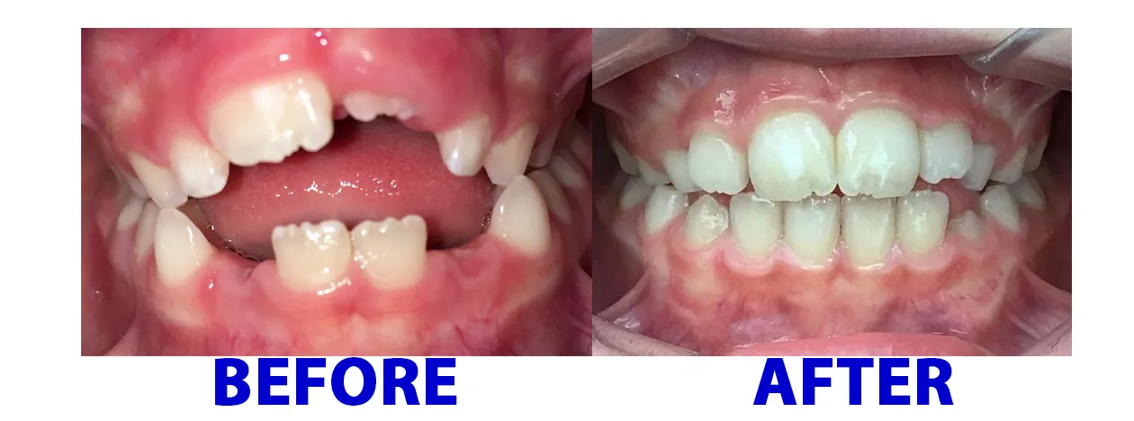 before and after teeth image for myobrace