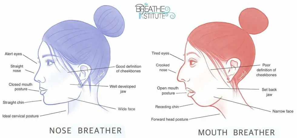 Myobrace breather image