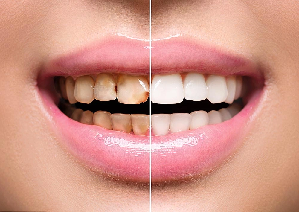 Woman-Teeth-before-and-after