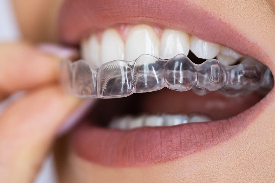 Can a Night Guard Protect My Teeth Even if I Do Not Have Jaw Pain