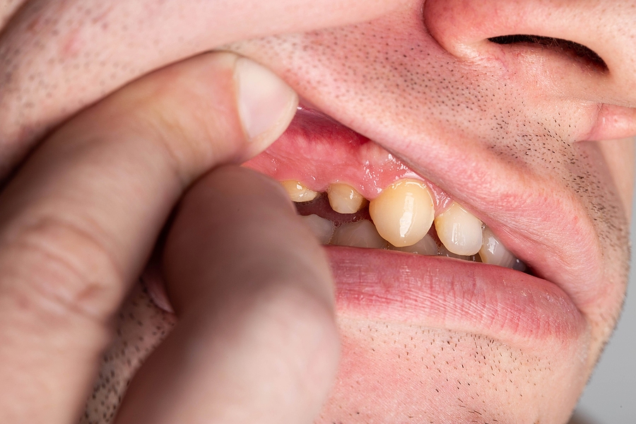 How Do I Know if Teeth Grinding Is Damaging My Smile
