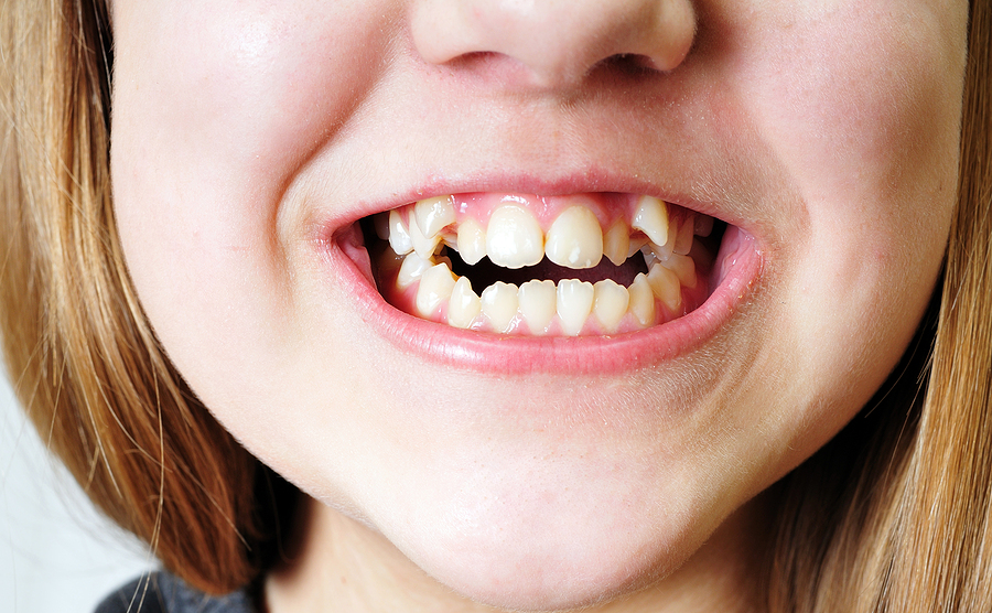 How Invisalign Treatment Fixes Crooked Teeth