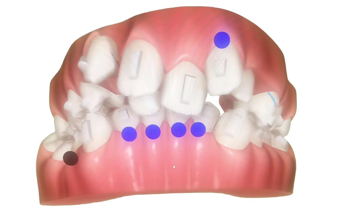 Inivisalign